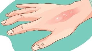 Uma mancha na queimadura (curada)